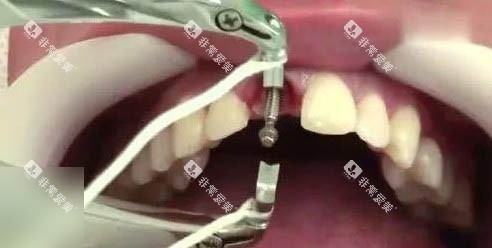 种植体手术细节图