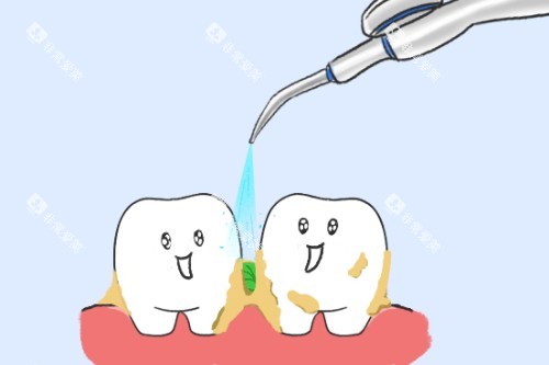 牙齿清洁展示图