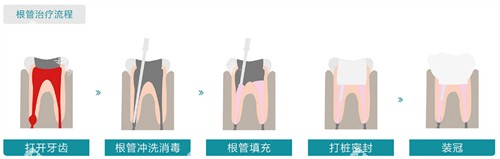 根管治疗流程图展示 根管治疗流程图展示