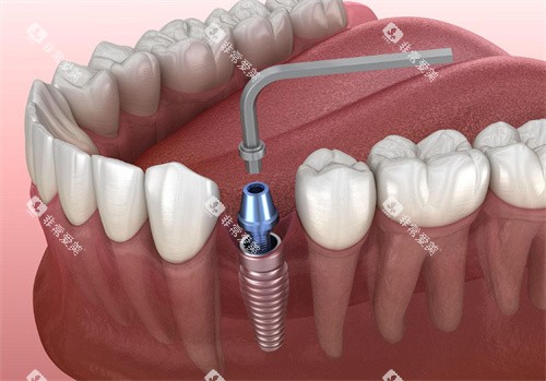 种植牙操作动画图片 种植牙操作动画图片
