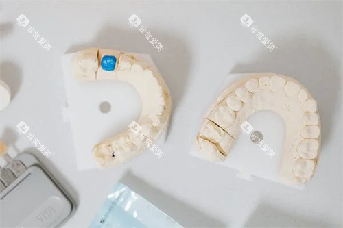 正畸咬合模型图