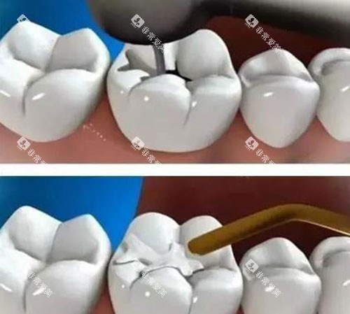 补牙过程示意图