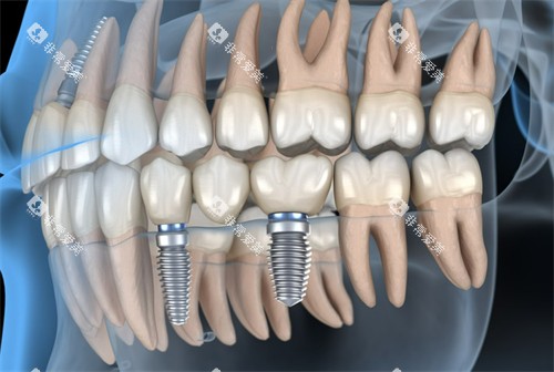 上海金山美信口腔种牙图示 上海金山美信口腔种牙图示