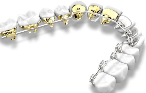 舌侧矫正示意图 舌侧矫正示意图