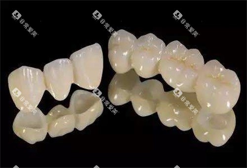 全瓷牙示意图 全瓷牙示意图