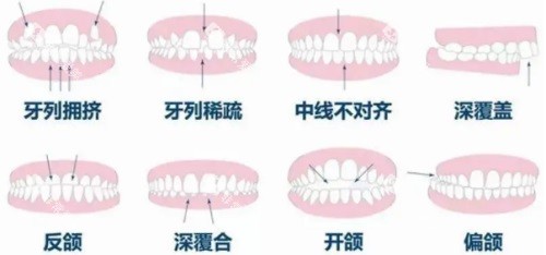 各种畸形牙齿示意图 各种畸形牙齿示意图