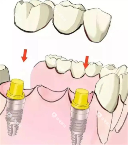 植体佩戴牙冠动画图 植体佩戴牙冠动画图