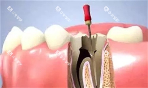 根管治疗示意图 根管治疗示意图