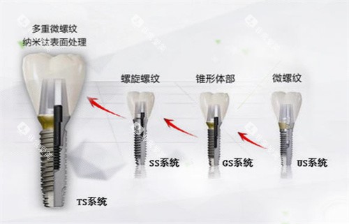 韩国奥齿泰种植体型号