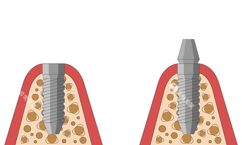 种植牙桩体展示