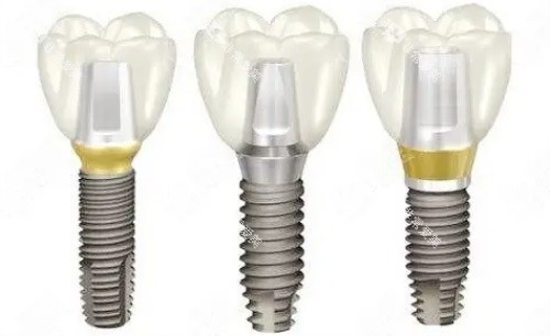 种植体示意图 种植体示意图