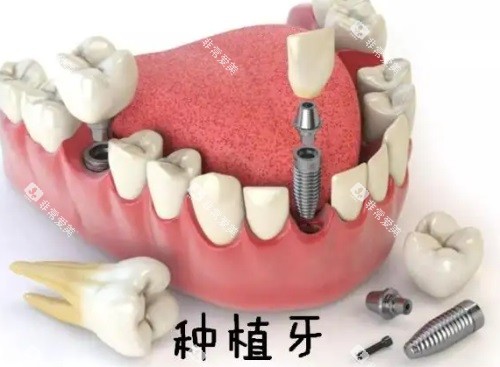 种植牙图 种植牙图