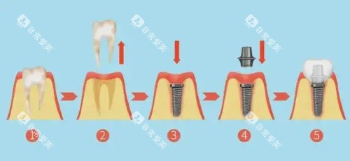 种植牙过程图片 种植牙过程图片