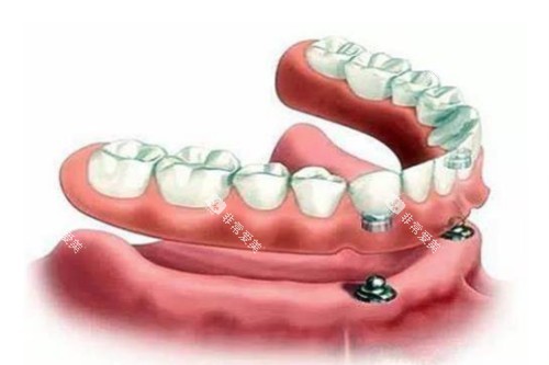 半口种植体模型图 半口种植体模型图
