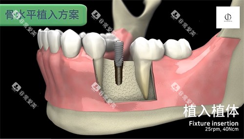韩一种植体怎么样 韩一种植体怎么样