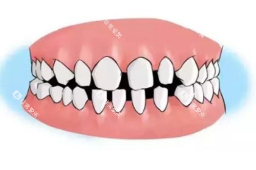 牙缝大卡通图 牙缝大卡通图