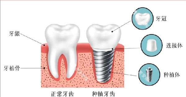 种植牙结构图