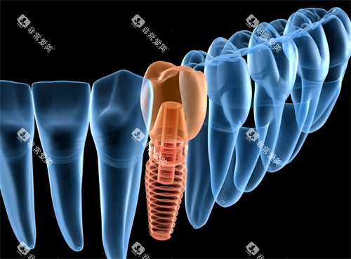 单颗种植牙演示图 单颗种植牙演示图