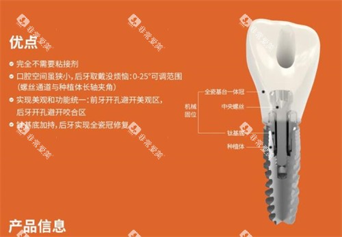 百齿泰植体优势有哪些