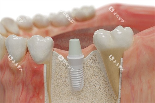 德国SKY种植牙植入模拟图