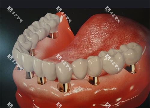 全口种植牙