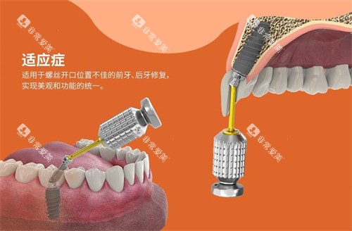 百齿泰植体适应症展示图