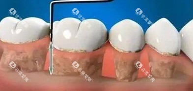 种植牙手术图片