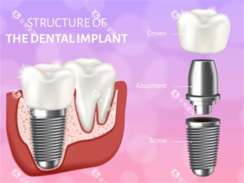 种植牙模拟示意图