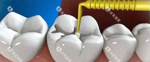 补牙治疗过程示意图