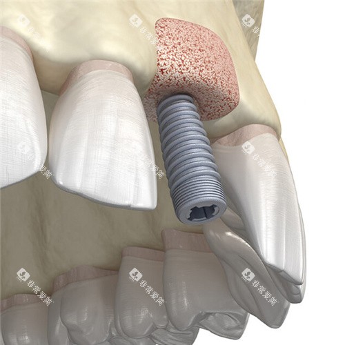 种植牙植骨