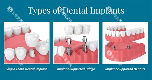 不同种植牙方式展示