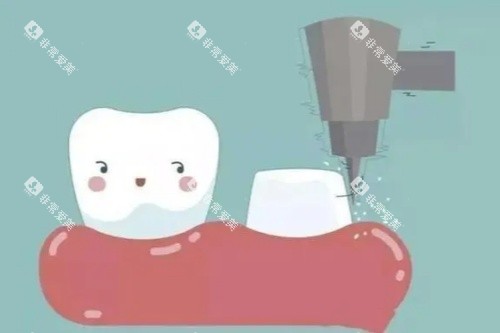 牙齿打桩卡通图