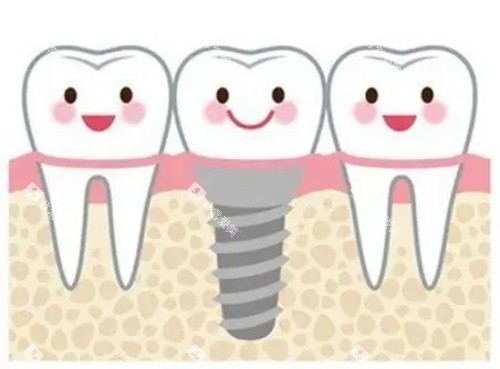 种牙的示意图 种牙的示意图