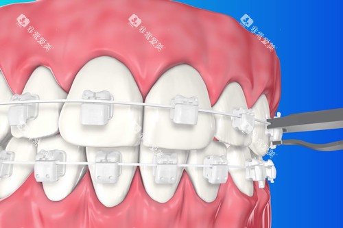 3M自锁托槽牙套示意图 3M自锁托槽牙套示意图