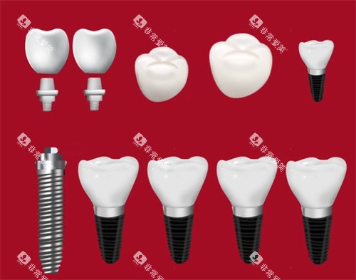 种植牙种植体牙冠 种植牙种植体牙冠