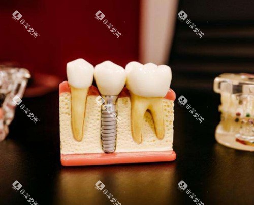 种植牙模具图 种植牙模具图