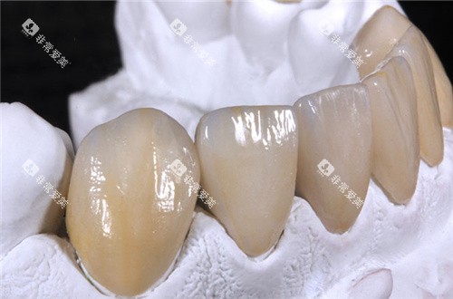 vita全瓷牙成品 vita全瓷牙成品