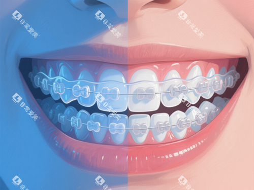 陶瓷牙套矫正 陶瓷牙套矫正