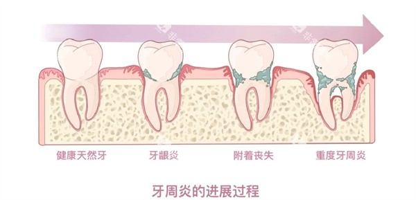 牙周炎 牙周炎