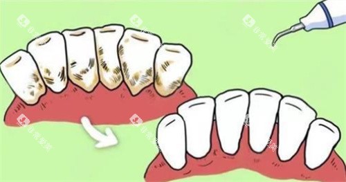 牙周炎治疗 牙周炎治疗