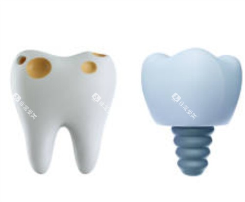 坏的牙齿和种植牙