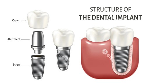 种植牙组成部分示意图 种植牙组成部分示意图