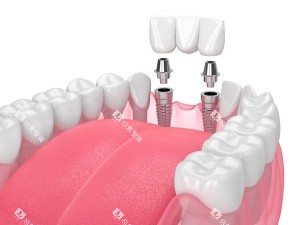 牙齿种植结构示意图