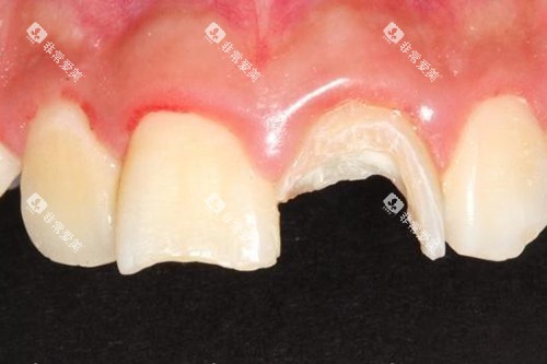 牙齿摔断实拍示意图