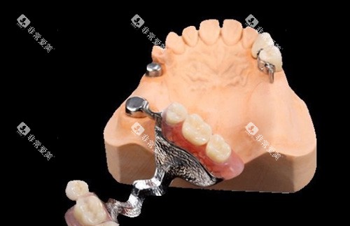 假牙细节照片 假牙细节照片