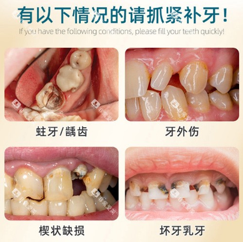 补牙适应症展示 补牙适应症展示