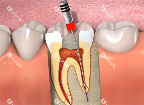 根管治疗动画展示