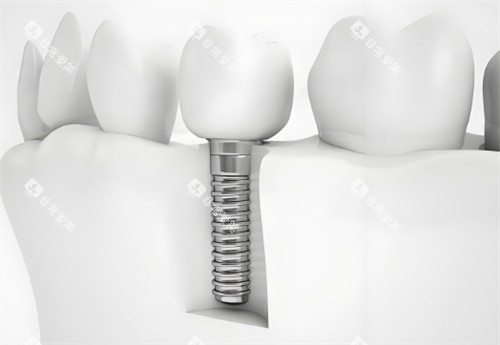 种植牙模型图片 种植牙模型图片