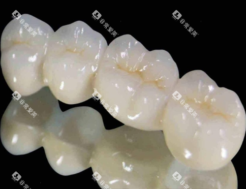 钯金烤瓷牙模型