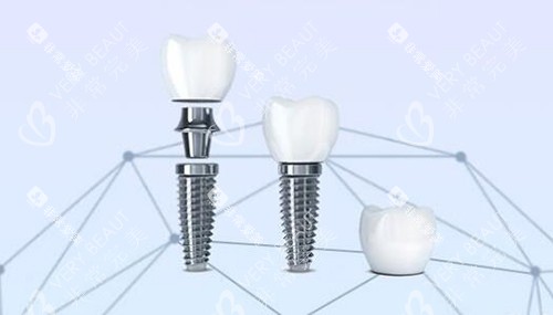 口腔种植牙改善